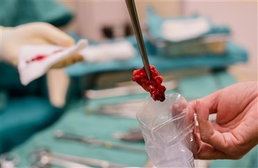 Biopsi – hvordan og hvorfor?